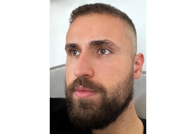 8 mesi dopo trapianto di barba zaffiro 3300-grafts-hu-le