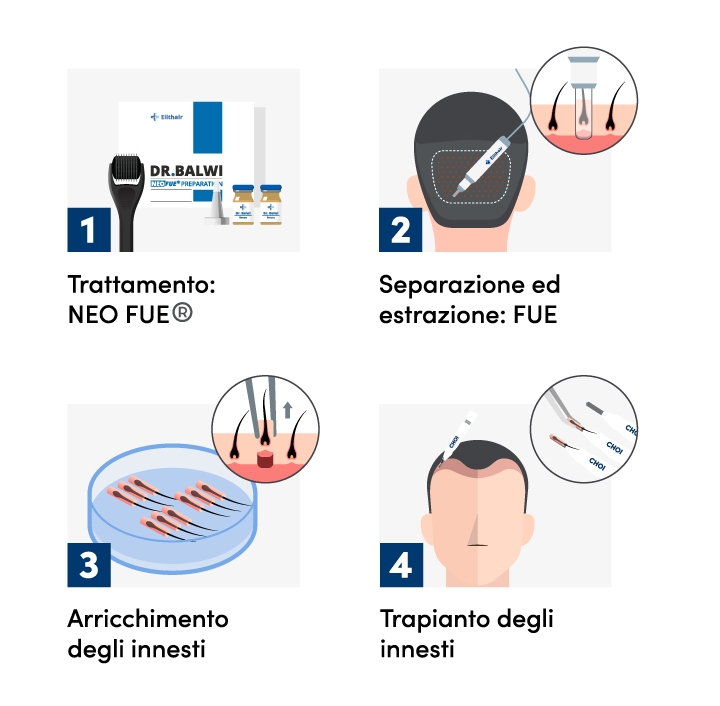 Infografica che mostra le 4 fasi della procedura del trapianto di capelli DHI