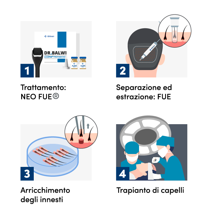 infografica che mostra le 4 fasi di un trapianto di capelli FUE