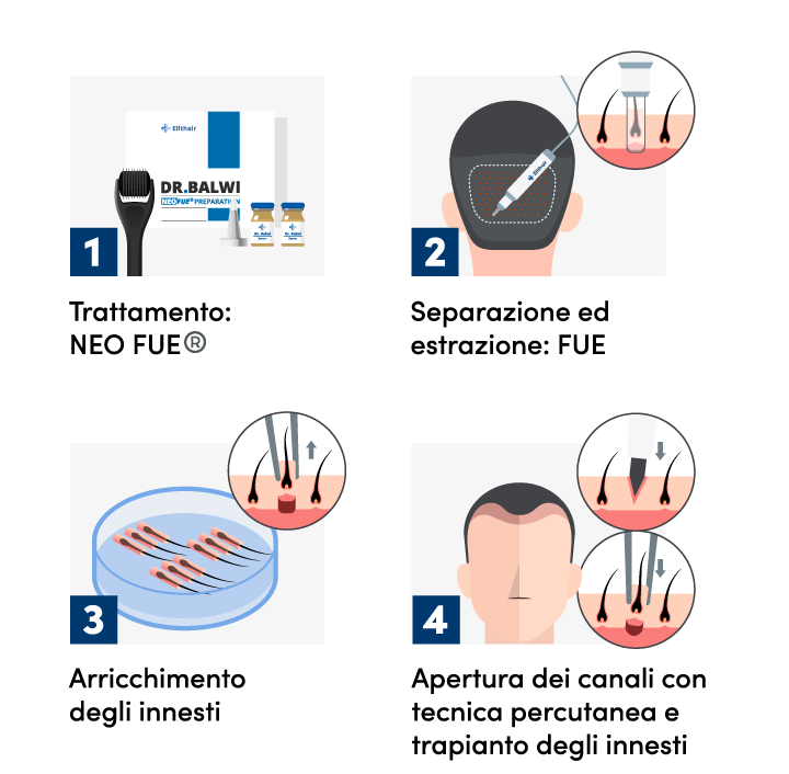 infografica che mostra le 4 fasi di un trapianto di capelli percutaneo
