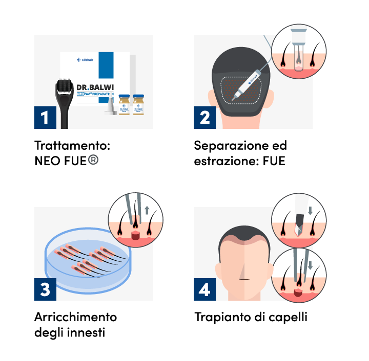 infografica che mostra le 4 fasi di un trapianto di capelli Zaffiro