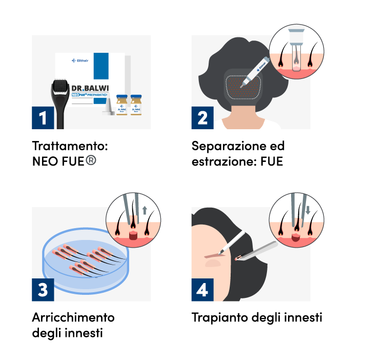 infografica che mostra le 4 fasi di un trapianto di capelli alle sopracciglia