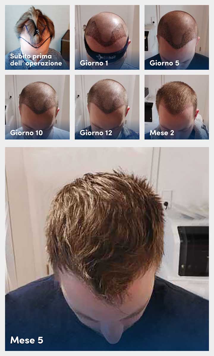 Infografica con foto che mostra le fasi del processo di guarigione e recupero dopo un trapianto di capelli dal primo giorno a cinque mesi
