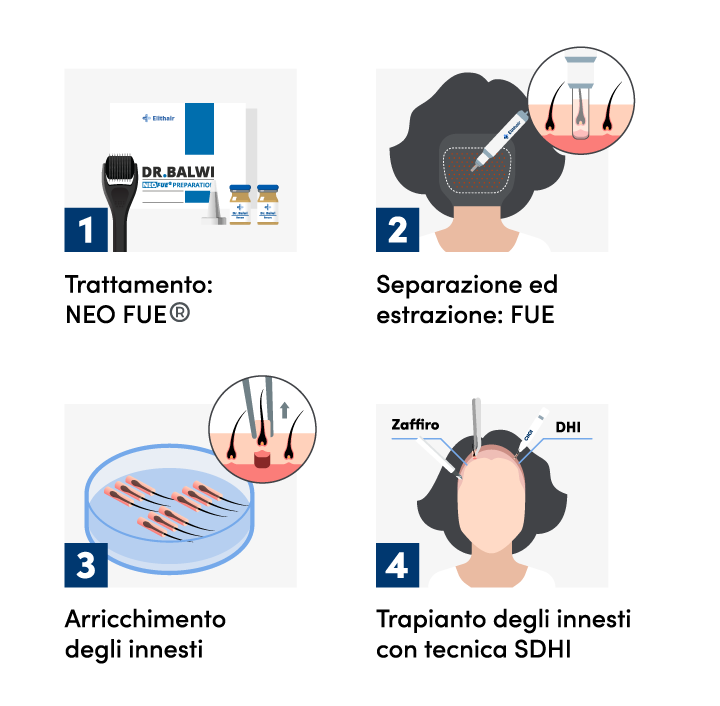 infografica che illustra le fasi di un trapianto di capelli per le donne