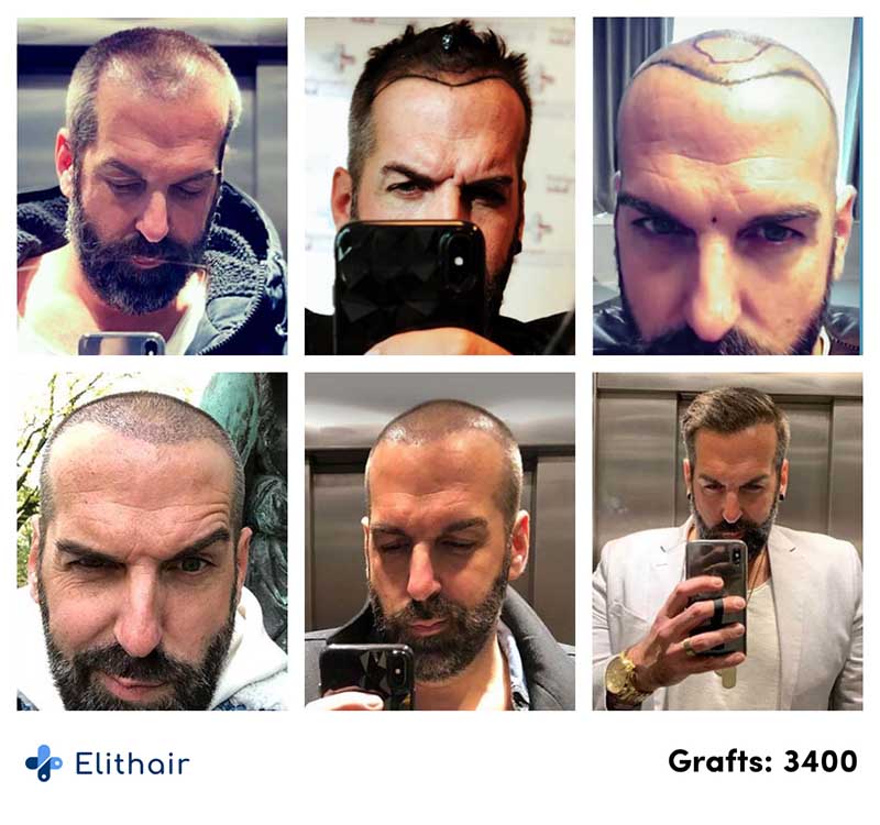 immagine del prima e del dopo del trapianto di capelli FUE di Juergen con 3400 innesti