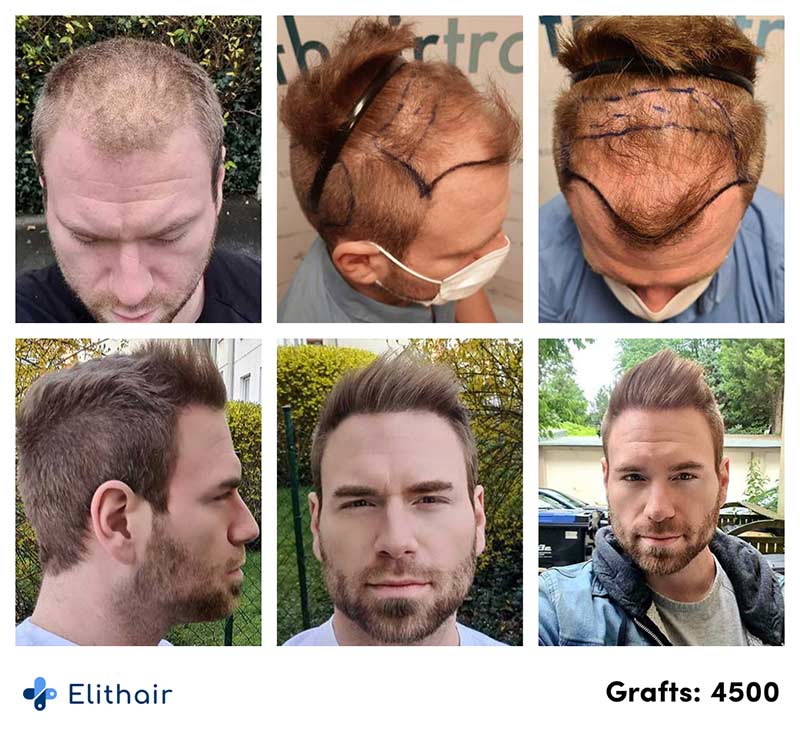 immagine del prima e del dopo del trapianto di capelli FUE di Kewin con 4500 innesti