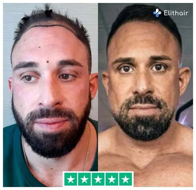 La foto mostra Kevin, paziente Elithair, prima e dopo il suo trapianto di capelli da 2700 grafts.