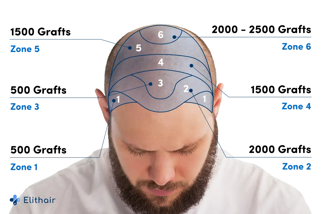 Mappa delle zone di perdita di capelli sul cuoio capelluto con il numero di innesti necessari per un trapianto presso Elithair