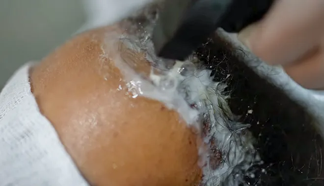 Lavaggio post-operatorio dei capelli presso la clinica Elithair dopo un trapianto di capelli. L'immagine mostra un tecnico che esegue un lavaggio delicato per proteggere i nuovi innesti.