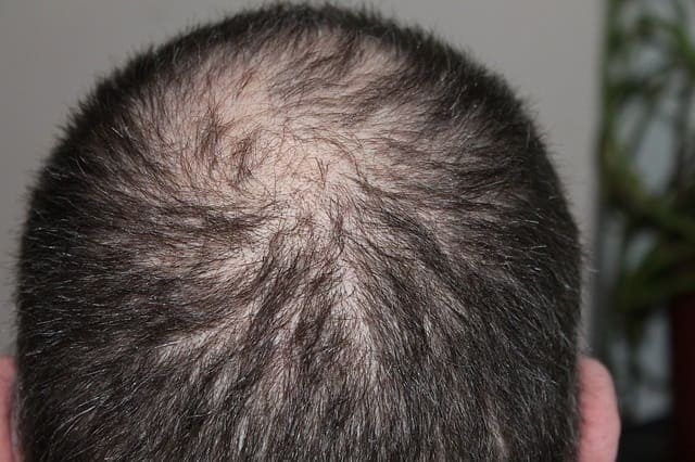 alopecia androgenética nos homens