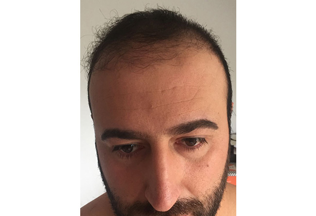 3 meses Depois Transplante cabelo FUE safira 2580 folículos do Artin Asrian