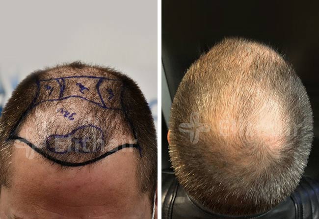 Antes Transplante cabelo FUE DHI 5200 foliculos do Andre Osiander