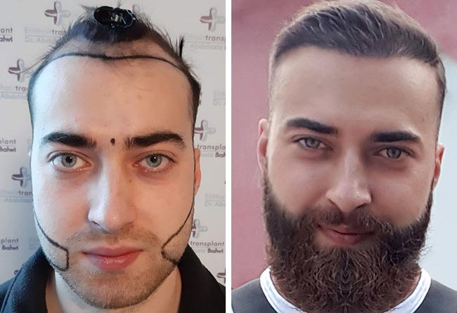 Antes e Depois Transplante barba FUE safira 4250 folículos do Andre Ulbrich