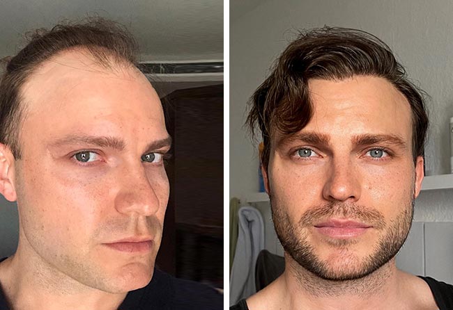 Antes e Depois Transplante cabelo FUE safira 3700 folículos do Edgars Noskovs