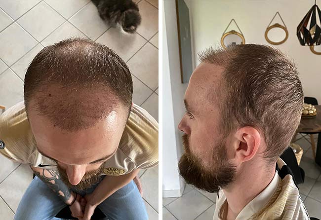 Depois 2 meses Transplante cabelo FUE safira 4700 folículos do Frederic Giger