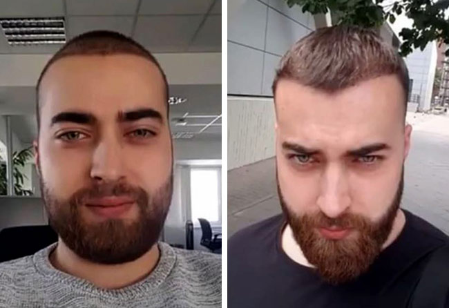 Depois 4 meses Transplante barba FUE safira 4250 folículos do Andre Ulbrich