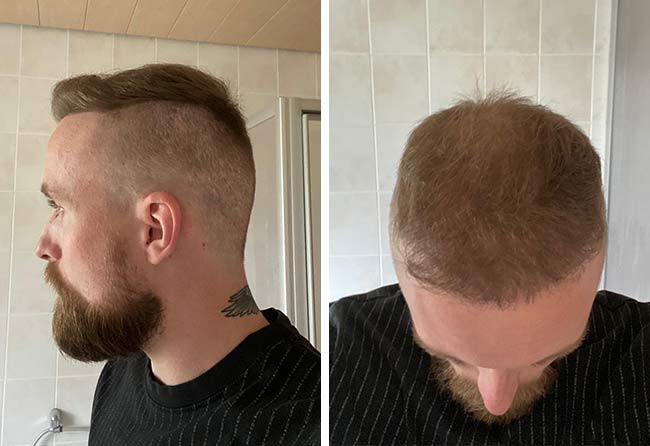Depois 6 meses Transplante cabelo FUE safira 4700 folículos do Frederic Giger