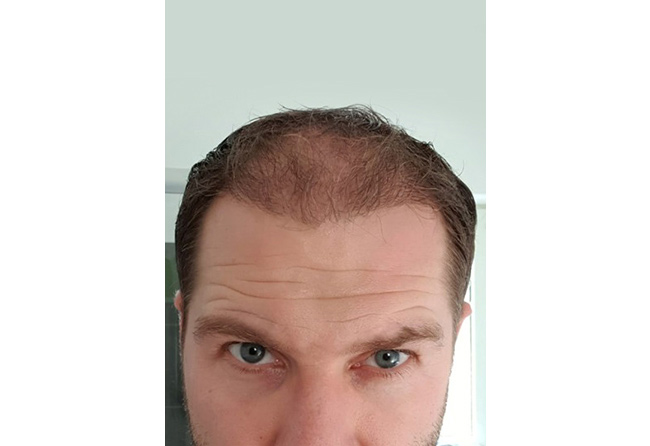 Resultado 3 meses Depois Transplante cabelo FUE Safira 4100 folículos do Marcus Medweg