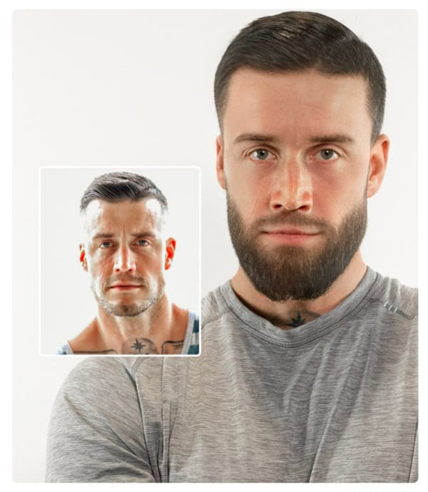 Imagem de um paciente após transplante de barba na Elithair