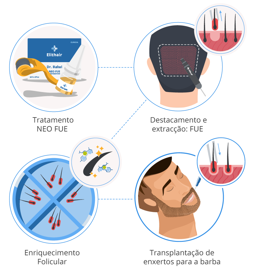 Imagem gráfica dos 4 passos de transplante de barba