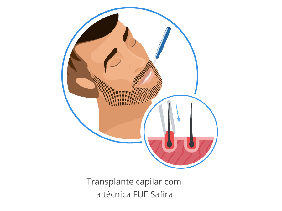 Imagen gráfica del implante de grafts en la barba con la técnica FUE Zafiro