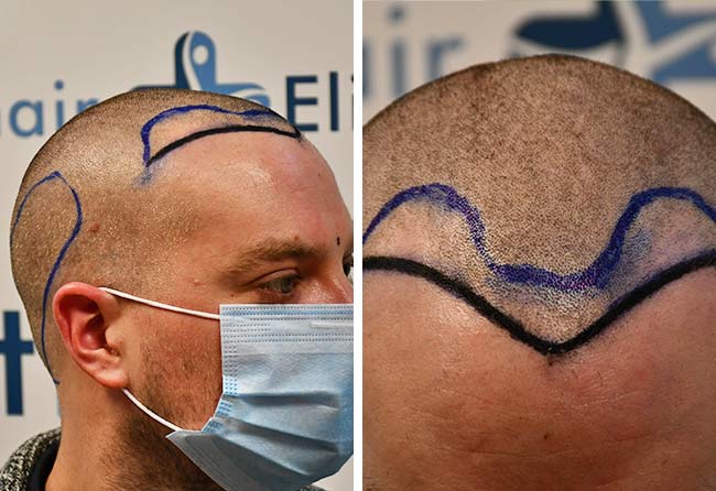 Antes do Transplante cabelo DHI-2000-grafts-Achim-Klein