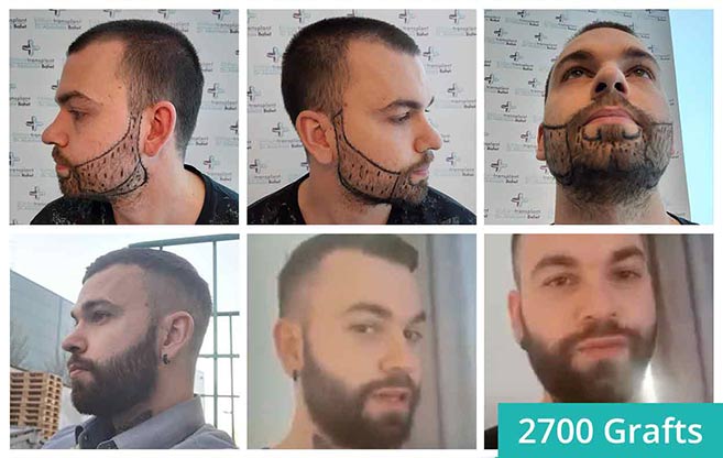 Antes e depois do transplante da barba Nico Müller