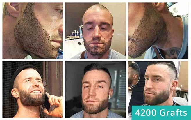 Antes e depois do transplante de barba de Jhaki