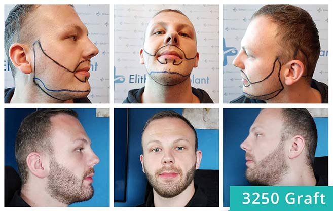 Antes e depois do transplante de barba de Sascha Lockemann