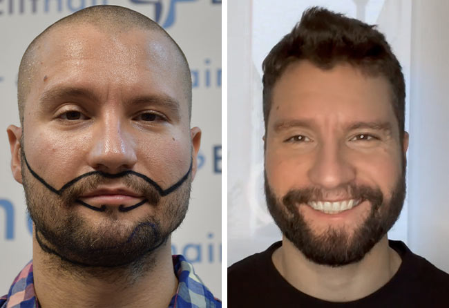 Antes e despois transplante capilar barba-3500-grafts-Dominik-Schmitz