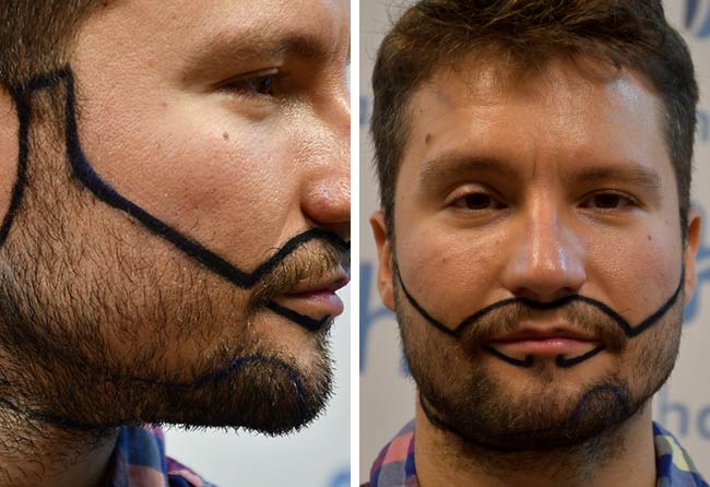 Antes transplante capilar barba-3500-grafts-Dominik-Schmitz