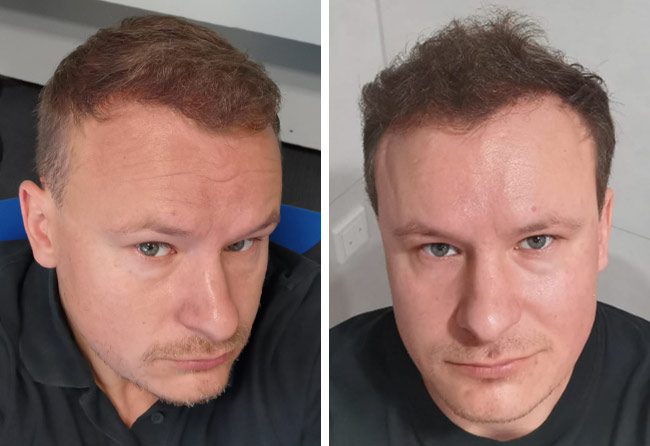 Resultado-Depois-Transplante-cabelo-FUE-safira-4200-foliculos-do-Sergej-Weresomski