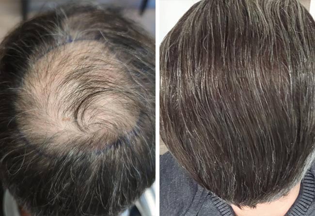 Antes-Depois-Transplante-cabelo-FUE-safira-3100-foliculos-do-Dani-el