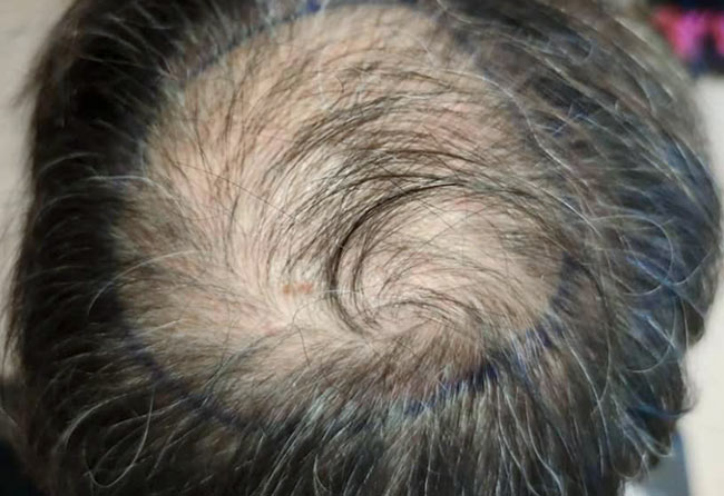 Antes-Transplante-cabelo-FUE-safira-3100-foliculos-do-Dani-el