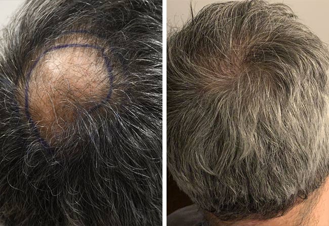 Antes-e-Depois-Transplante-cabelo-FUE-safira-3000-foliculos-do-Ziad-Ma