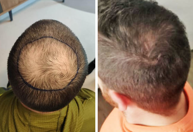 Antes-e-Depois-Transplante-cabelo-FUE-safira-4000-foliculos-do-tho-marky