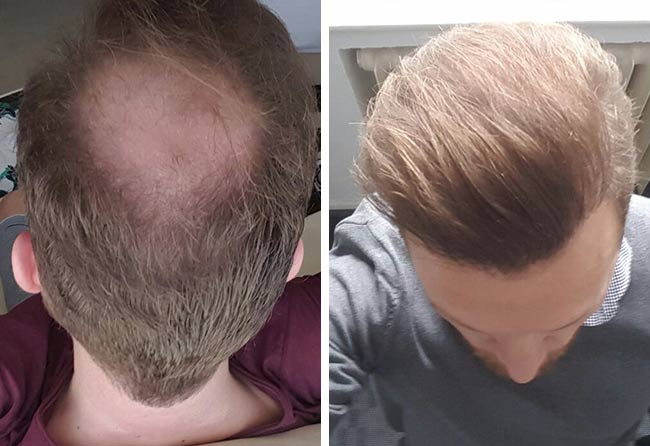 Antes-e-depois-Transplante-cabelo-FUE-safira-3700-foliculos-do-Stefan-Heckmann