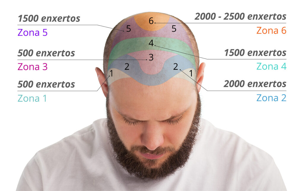 Gráfico do número de enxertos por zona para transplante de cabelo