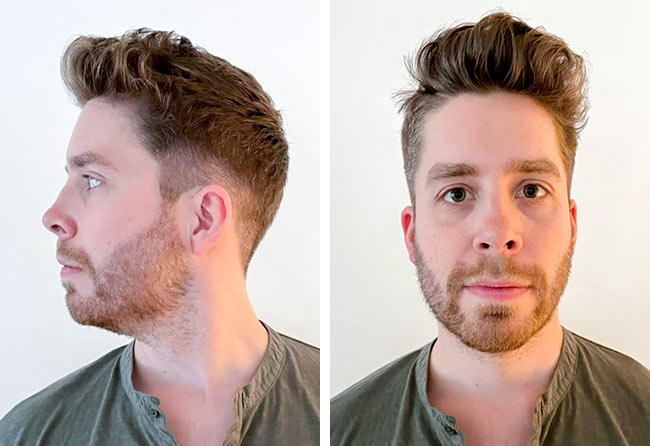 4 meses Depois Transplante barba FUE safira 3200 folículos do Eike R.