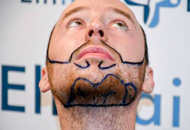 Antes do Transplante barba safira 3700 grafts Felix-v