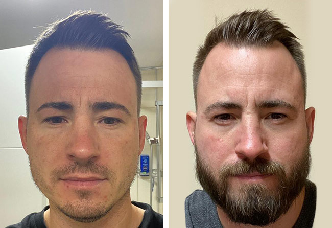 Antes depois do Transplante barba 4200 enxertos Steven A