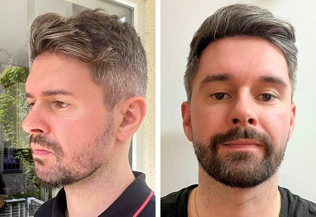 Antes e Depois Transplante barba FUE safira 4250 grafts Ismar S.
