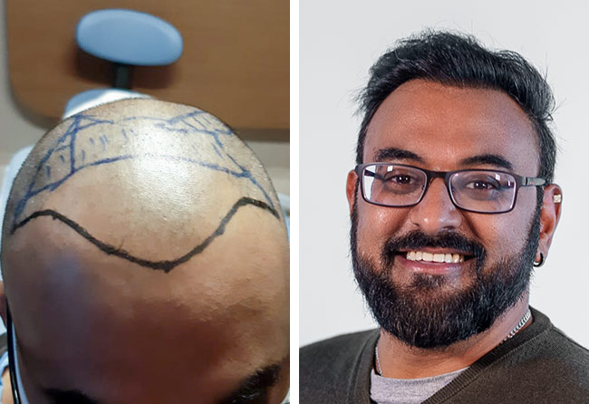Antes e depois do transplante capilar DHI com 4000 enxertos do nosso paciente Shahid A.