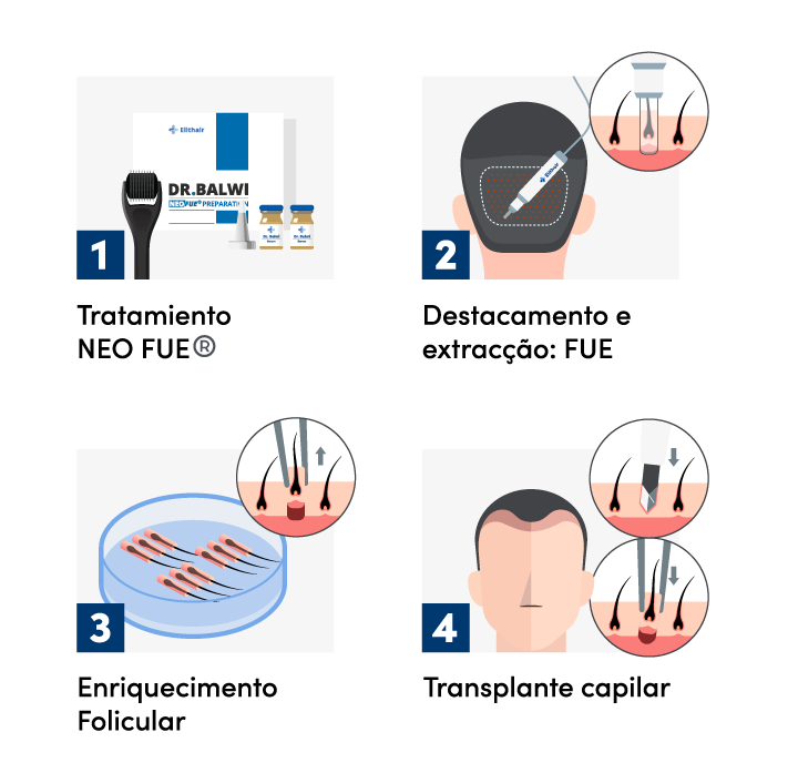 Imagem gráfica dos 4 passos de um procedimento de transplante capilar safira na Elithair.