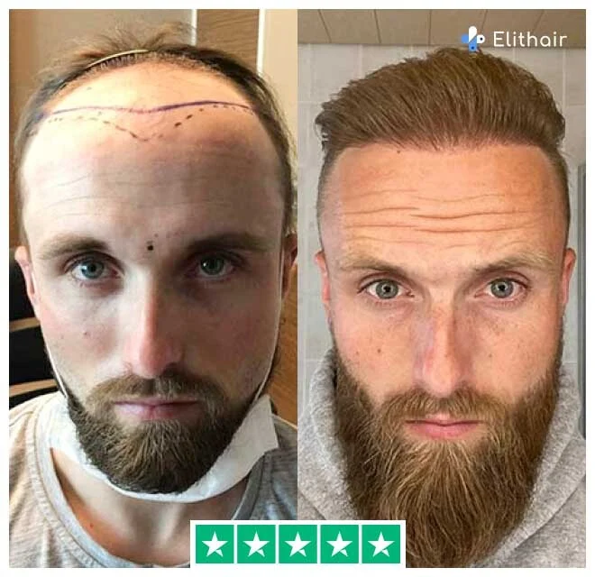 A foto mostra Frederik, um paciente da Elithair, antes e depois do seu transplante capilar com 4700 enxertos.