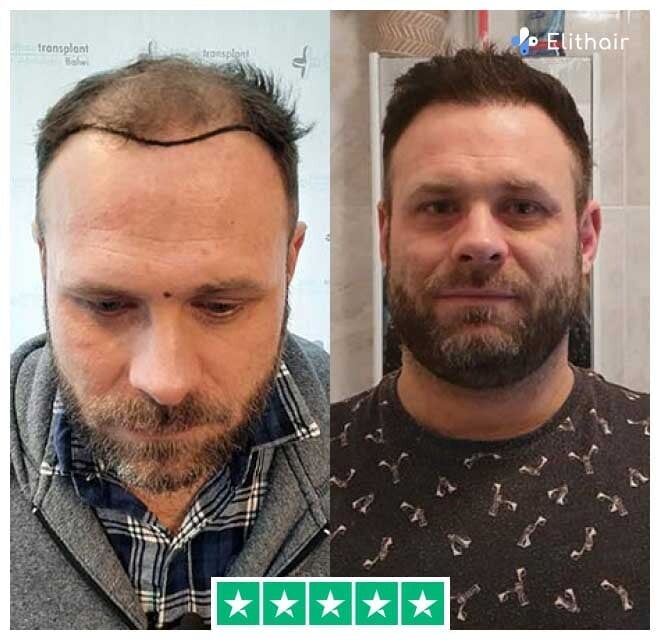 A fotografia mostra o paciente Elithair Michael antes e depois do seu transplante capilar de 3700 enxertos.