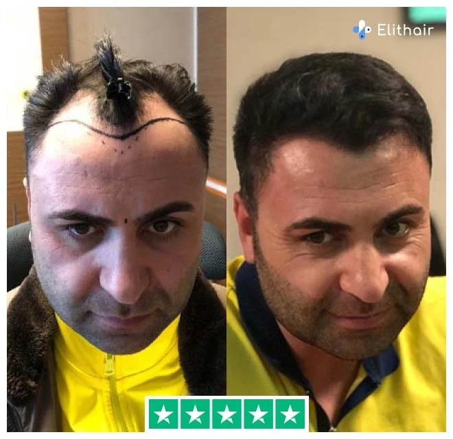 A fotografia mostra o paciente Elithair Murat antes e depois do seu transplante capilar de 2700 enxertos.