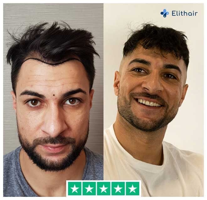 A fotografia mostra o paciente Elithair Osmani antes e depois do seu transplante capilar de 2200 enxertos.