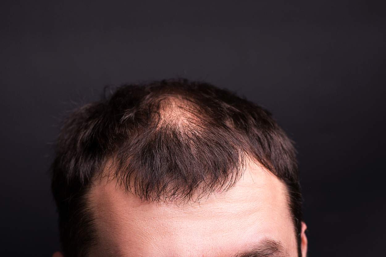 Hombre con alopecia androgenética