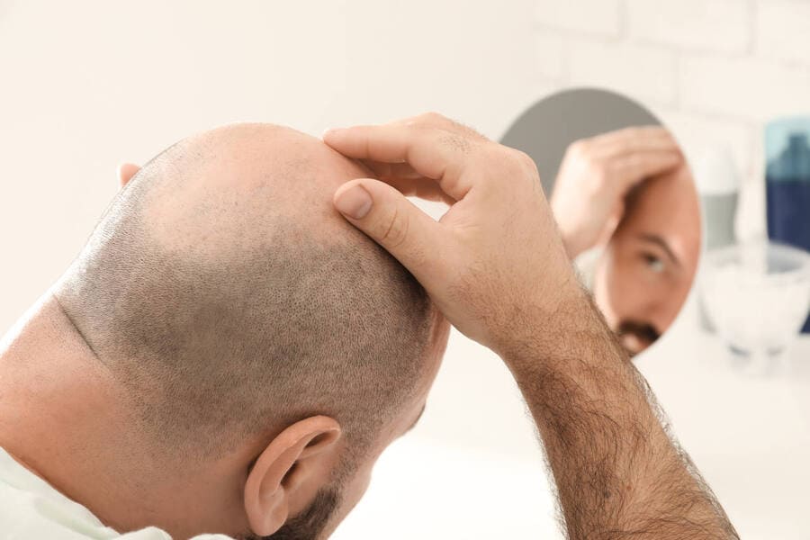 Hombre preguntándose qué tipo de alopecia padece.